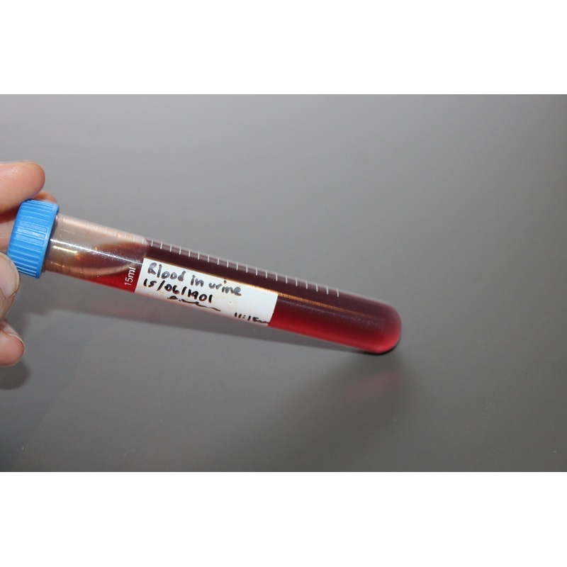 Simulated Blood in Urine Medical Specimen Tube